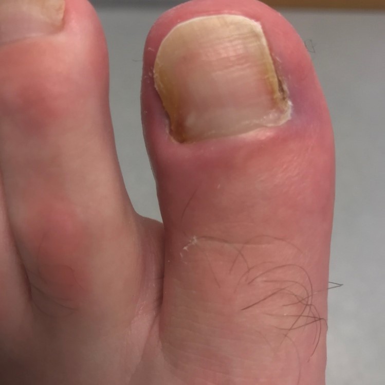 Surgical Treatment for Ingrowing Toenails