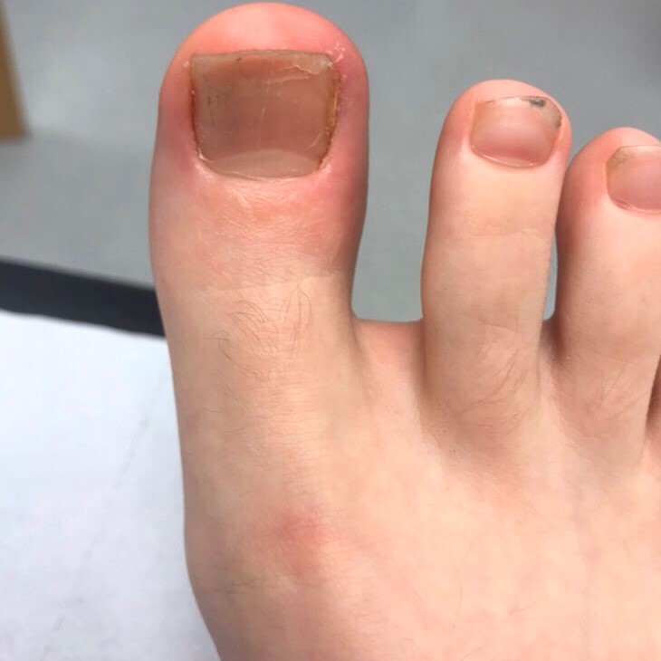 Surgical Treatment for Ingrowing Toenails