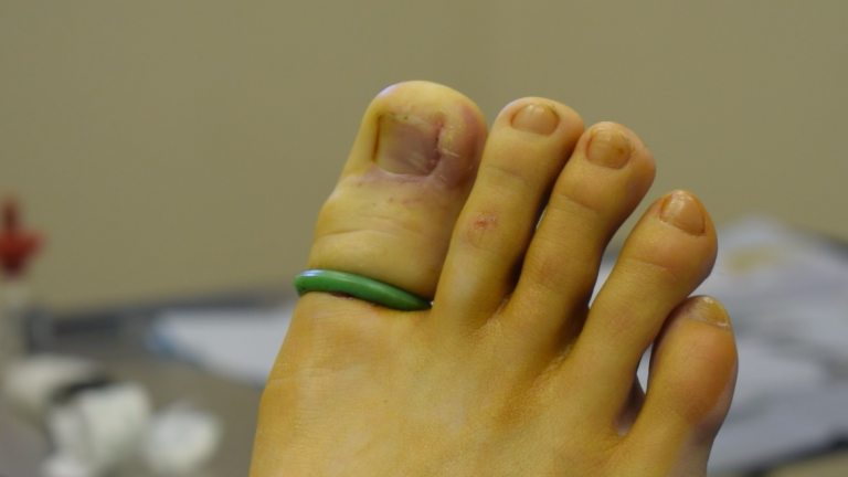 Partial Nail Avulsion for Ingrown Toenail - Trevor Lane Podiatry